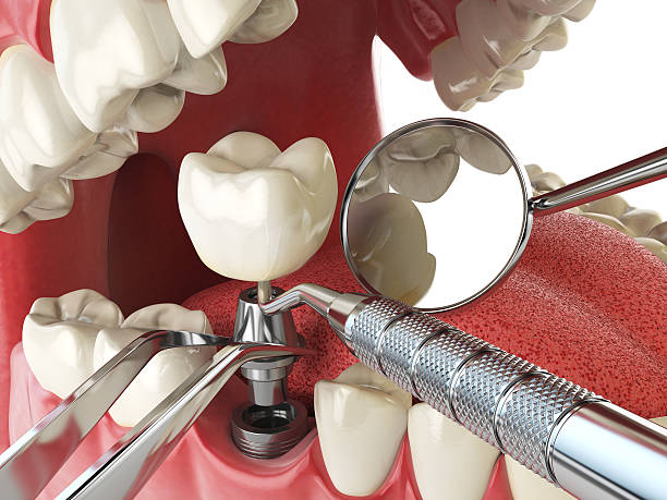 Best Emergency Dentist for Lost Fillings or Crowns in Heeia, HI